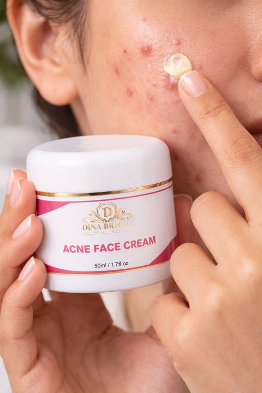 ACNE FACE CREAM